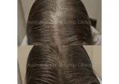 Experience Safe & Effective Solutions for Hair Loss in Adelaide